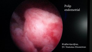 polip endometrial